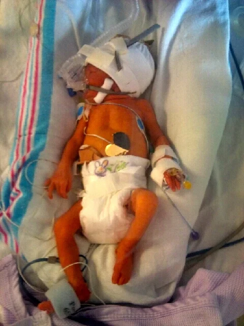  My Son born premature at 30 weeks fighting to survive. 